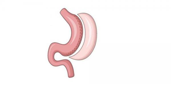 SLEEVE GASTRECTOMY