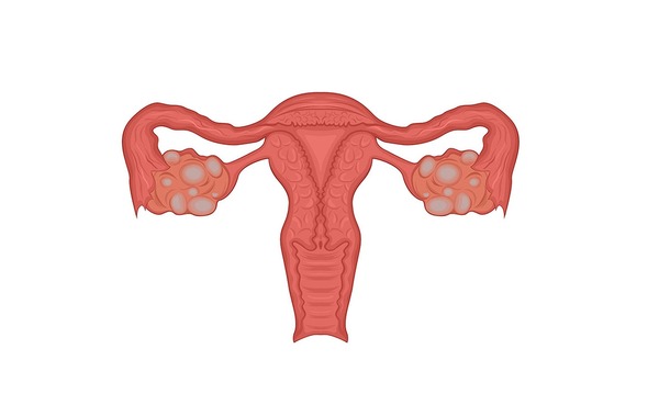 UTERINE FIBROIDS