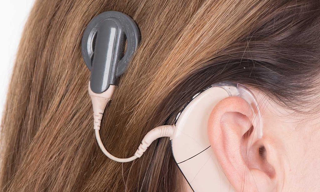 L'IMPLANTS COCHLÉAIRE