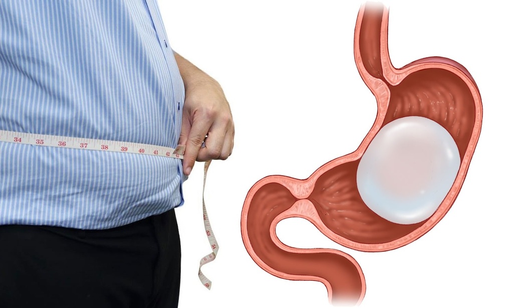 BALLON GASTRIQUE